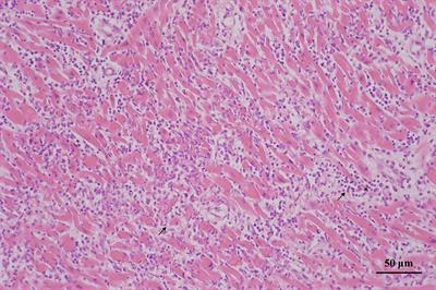 Case report: Myocarditis following COVID-19 protein subunit vaccination